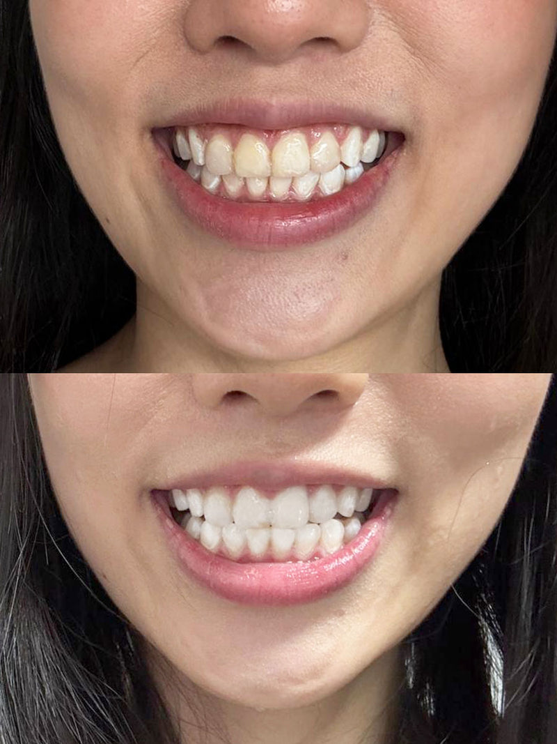 I love how clean and comfortable this feels. My smile looked brighter without any sting.