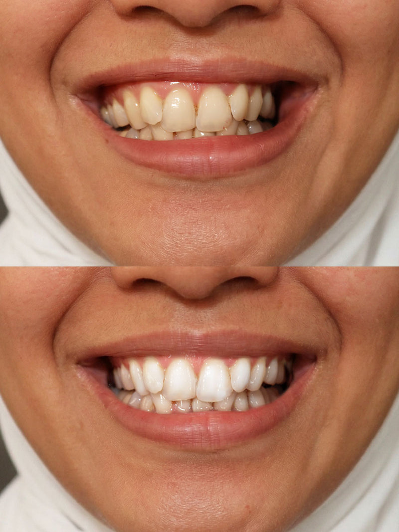 The strips helped with long-term stains, and the pen is my quick touch-up before meetings. So easy.